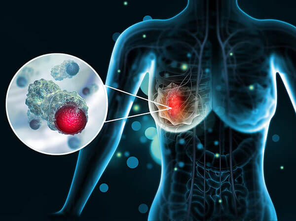 Breast Cancer