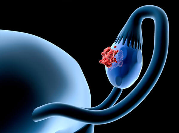 Ovarian Cystic Mass