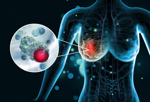 Breast Cancer