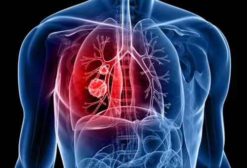 Thoracic Cancer