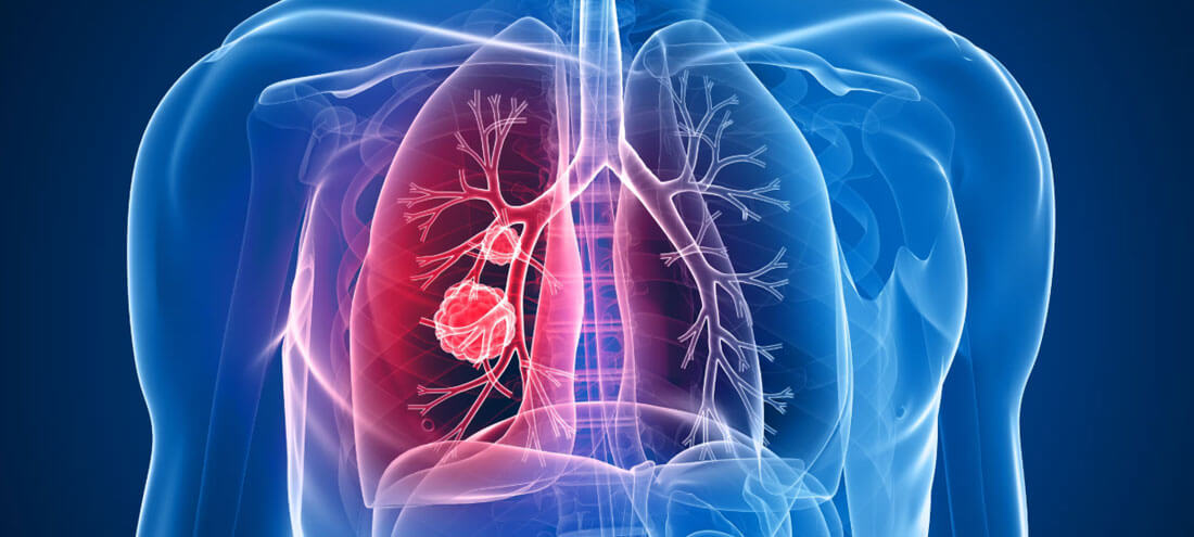 Thoraric Cancer