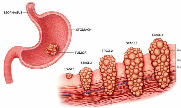 Stomach Cancer
